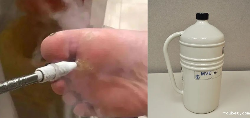 液氮治疗 液氮治疗